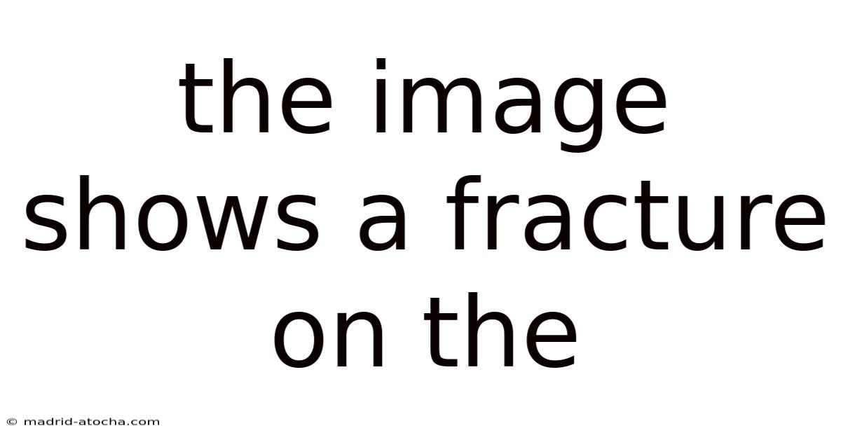 The Image Shows A Fracture On The